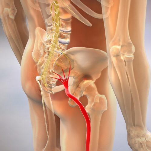 Sciatic Pinched Nerve 3D Render Sciatic Pinched Nerve 3D Render