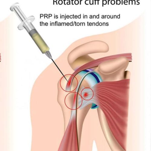 terapia-cu-autopasma-centruderecuperaremedicalaBrasov-servicii